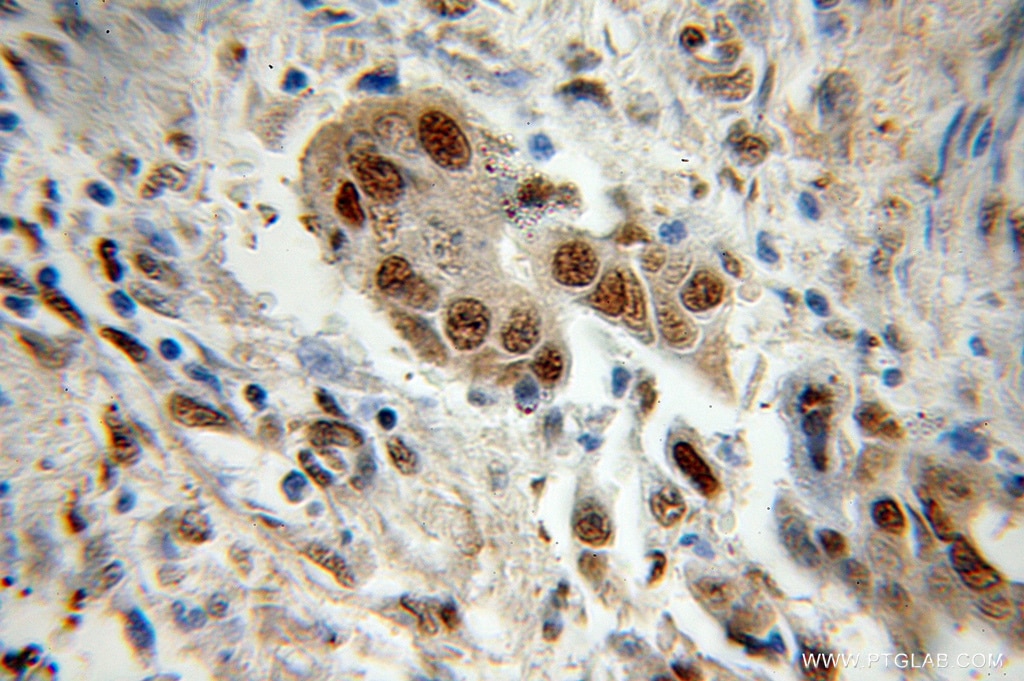 Immunohistochemistry (IHC) staining of human colon cancer tissue using PSMA1 Polyclonal antibody (11175-1-AP)