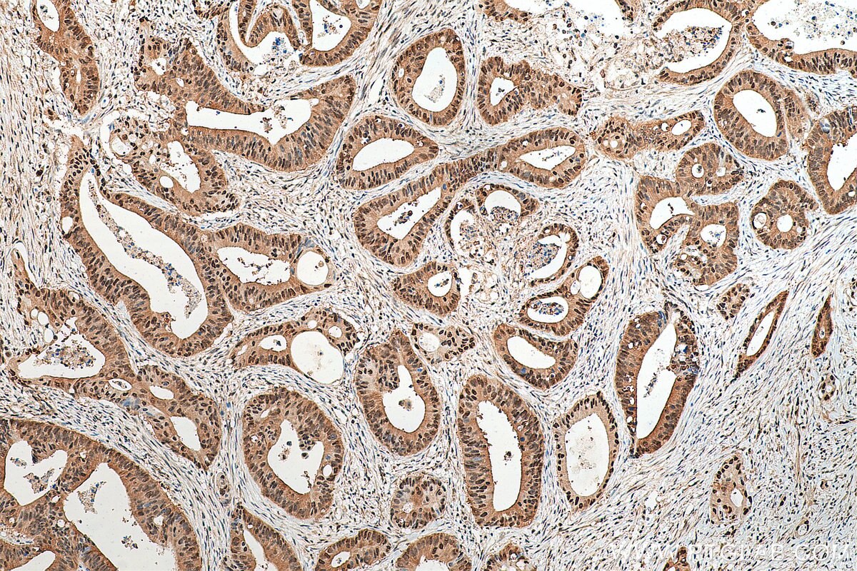 Immunohistochemistry (IHC) staining of human colon cancer tissue using PSMA1 Monoclonal antibody (67910-1-Ig)