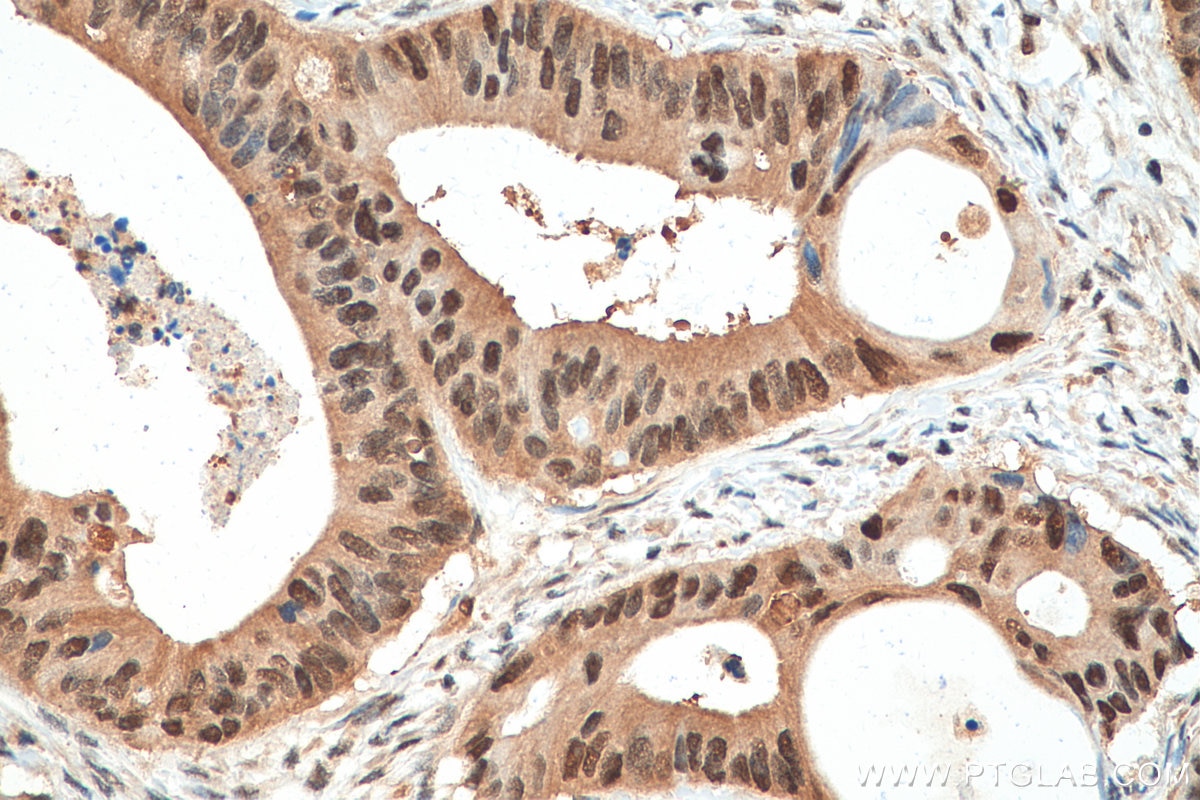 Immunohistochemistry (IHC) staining of human colon cancer tissue using PSMA1 Monoclonal antibody (67910-1-Ig)