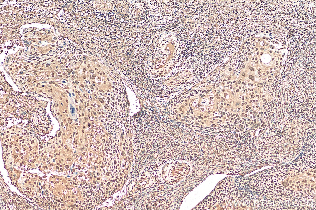 Immunohistochemistry (IHC) staining of human cervical cancer tissue using PSMA2 Monoclonal antibody (68240-1-Ig)