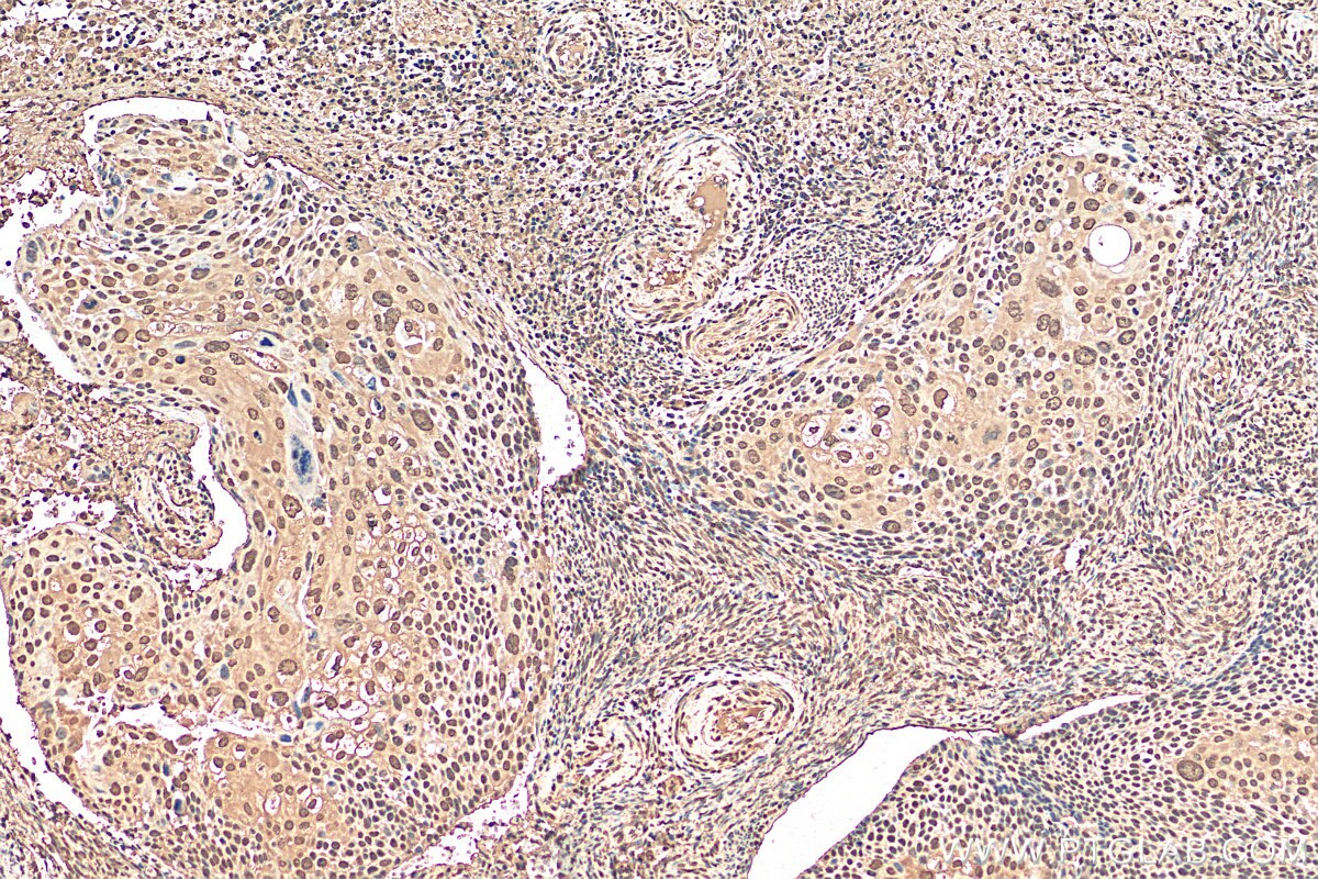 IHC staining of human cervical cancer using 68240-1-Ig