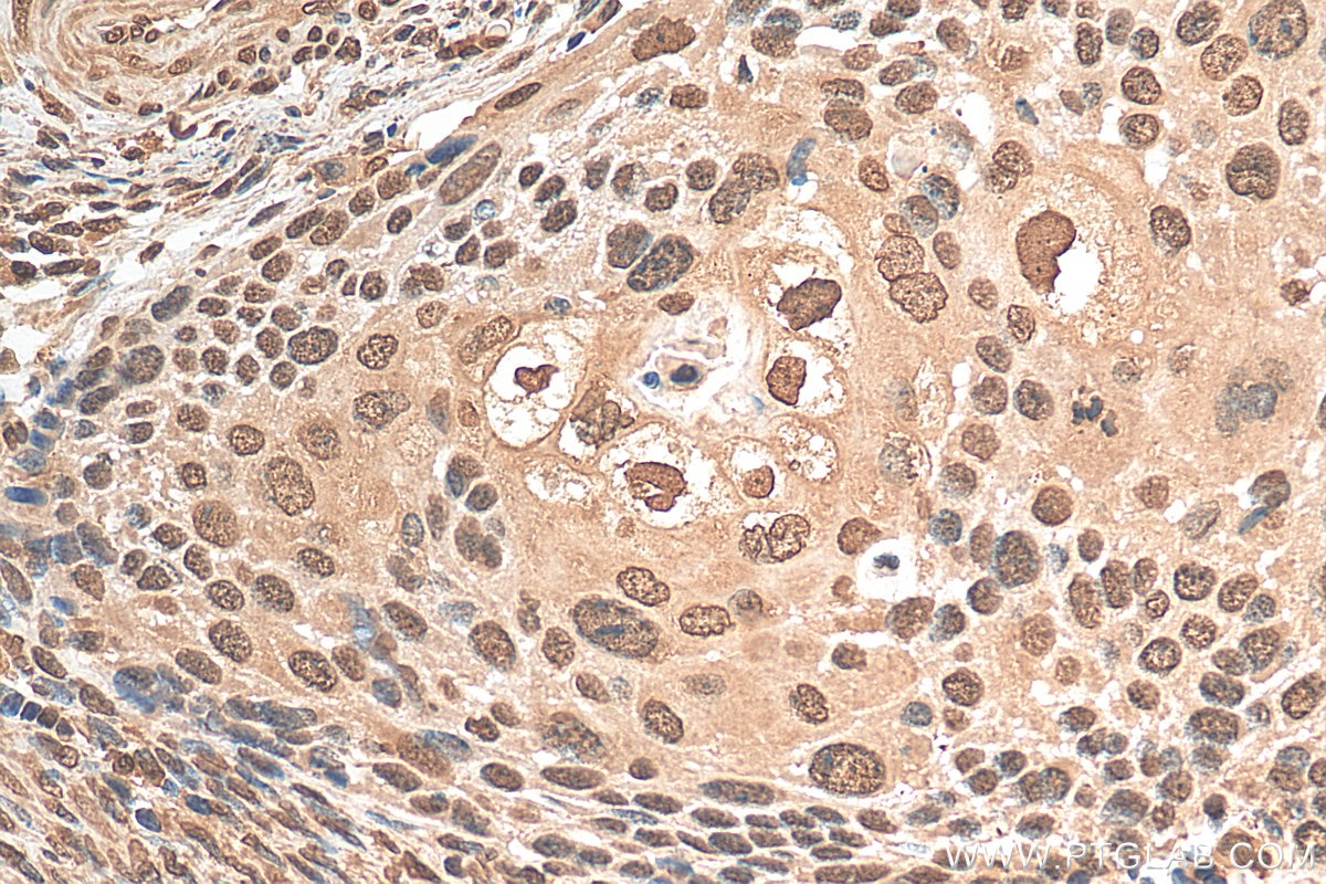 IHC staining of human cervical cancer using 68240-1-Ig