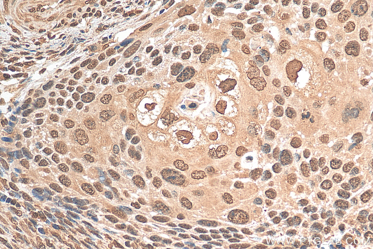 Immunohistochemistry (IHC) staining of human cervical cancer tissue using PSMA2 Monoclonal antibody (68240-1-Ig)