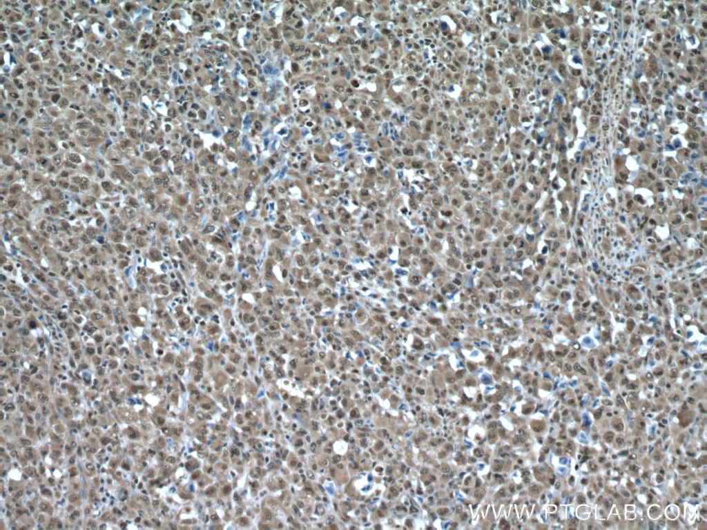 Immunohistochemistry (IHC) staining of human lymphoma tissue using PSMA3 Polyclonal antibody (11887-1-AP)