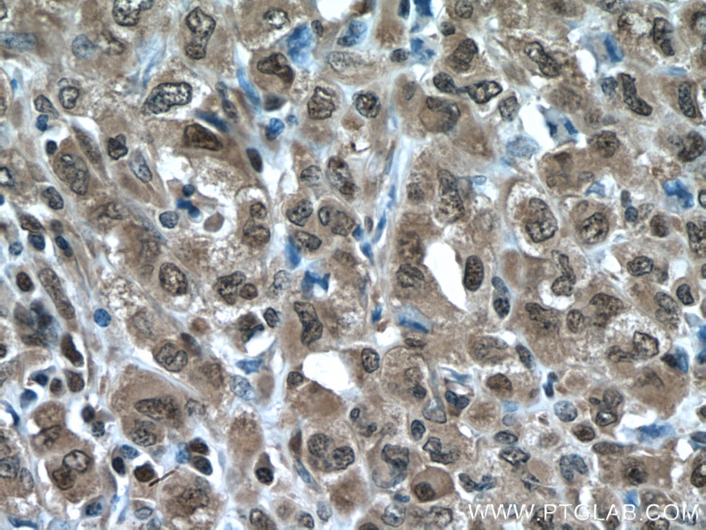 Immunohistochemistry (IHC) staining of human lymphoma tissue using PSMA3 Polyclonal antibody (11887-1-AP)