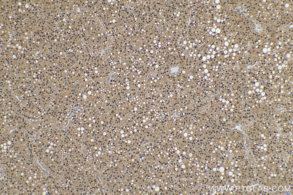 Immunohistochemistry (IHC) staining of human liver cancer tissue using PSMA3 Polyclonal antibody (11887-1-AP)
