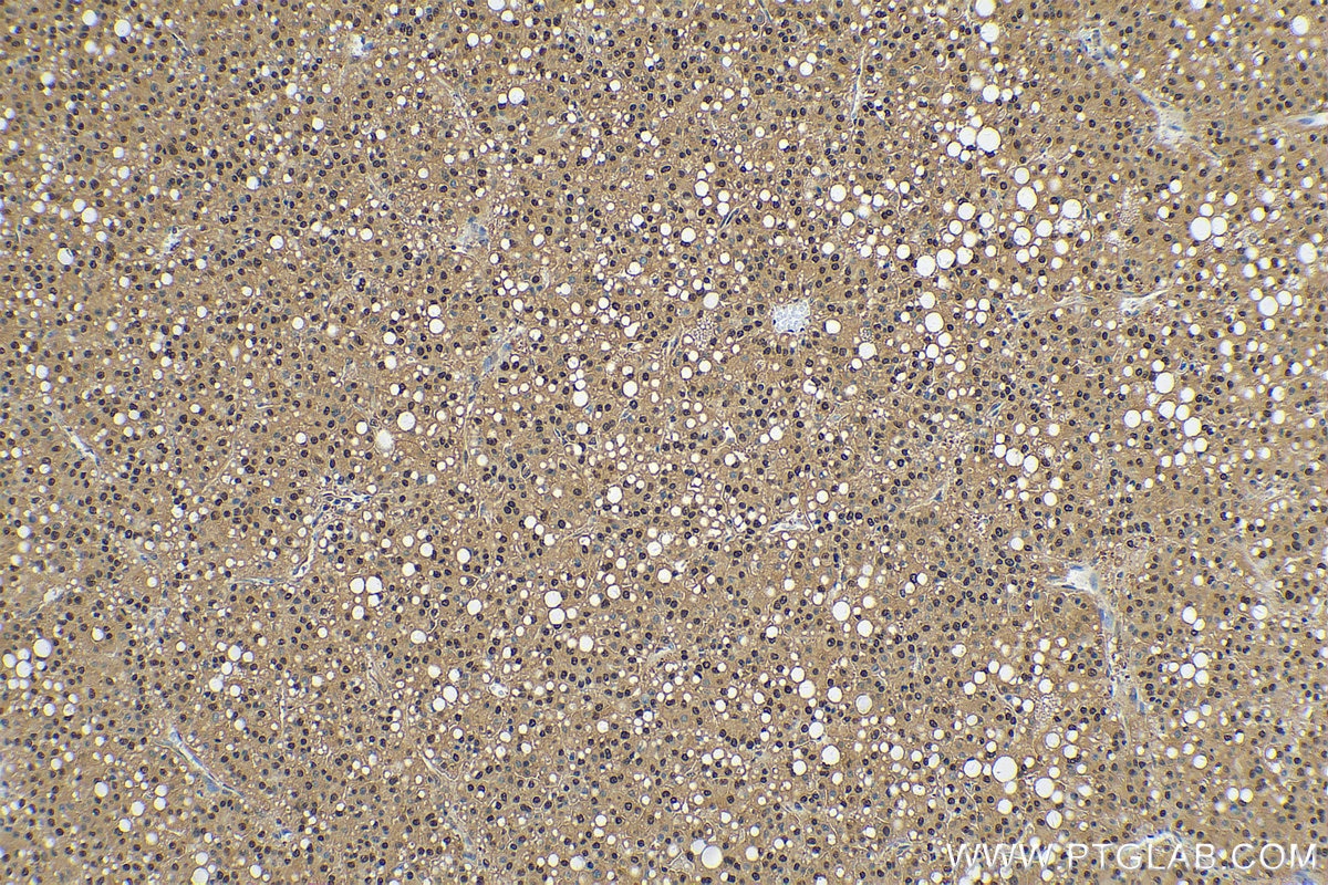 Immunohistochemistry (IHC) staining of human liver cancer tissue using PSMA3 Polyclonal antibody (11887-1-AP)