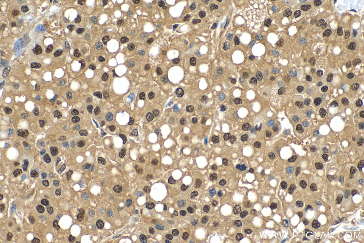 IHC staining of human liver cancer using 11887-1-AP
