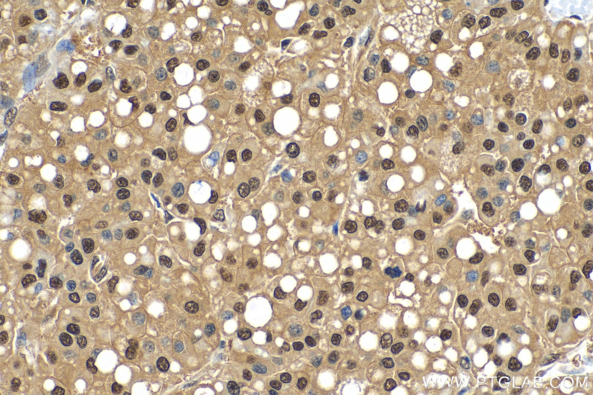 Immunohistochemistry (IHC) staining of human liver cancer tissue using PSMA3 Polyclonal antibody (11887-1-AP)