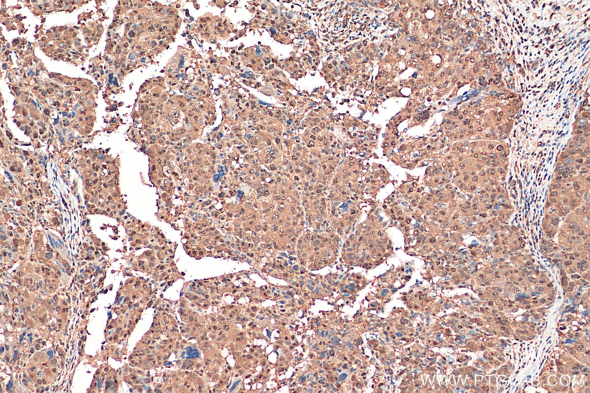 IHC staining of human liver cancer using 67938-1-Ig