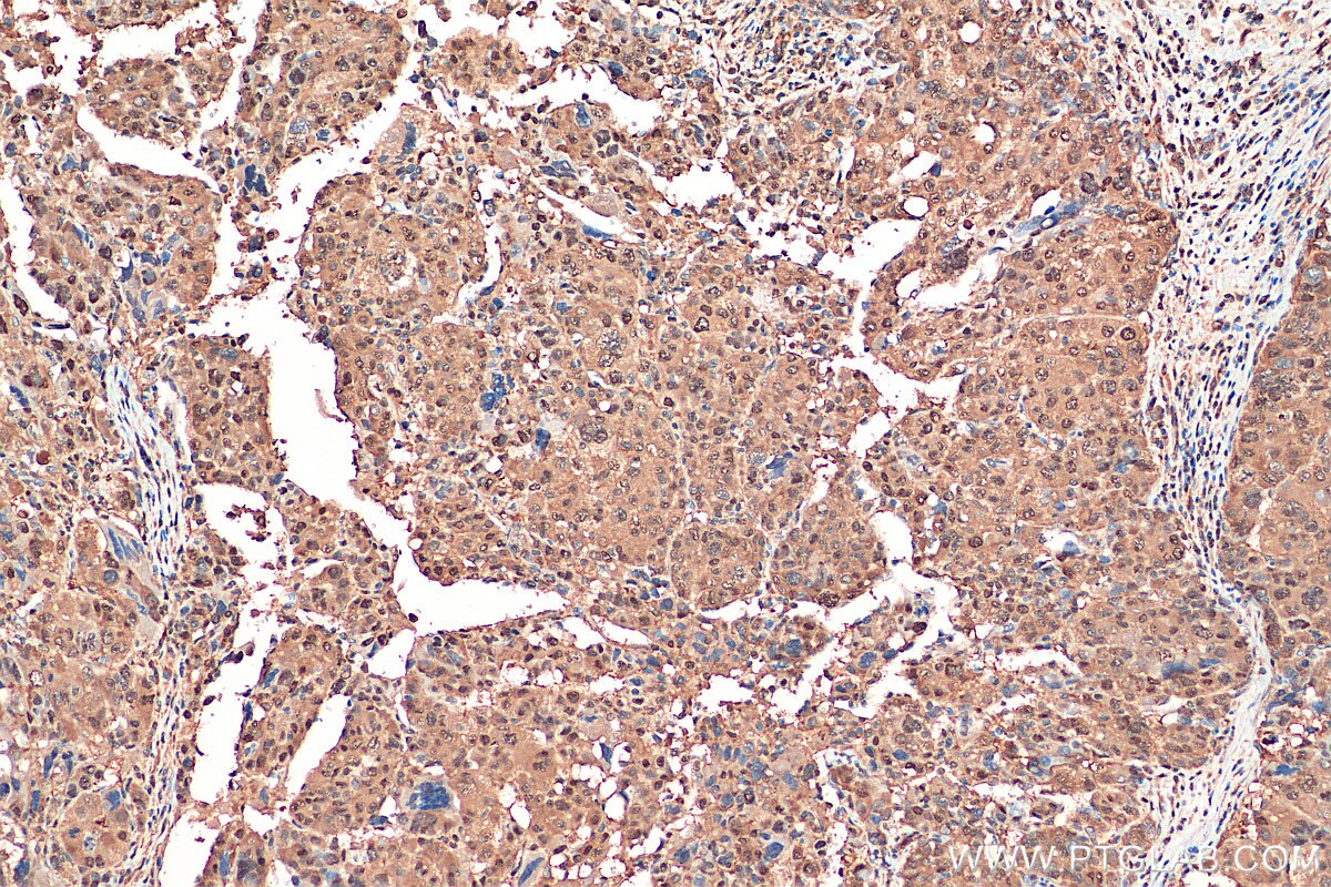 Immunohistochemistry (IHC) staining of human liver cancer tissue using PSMA3 Monoclonal antibody (67938-1-Ig)