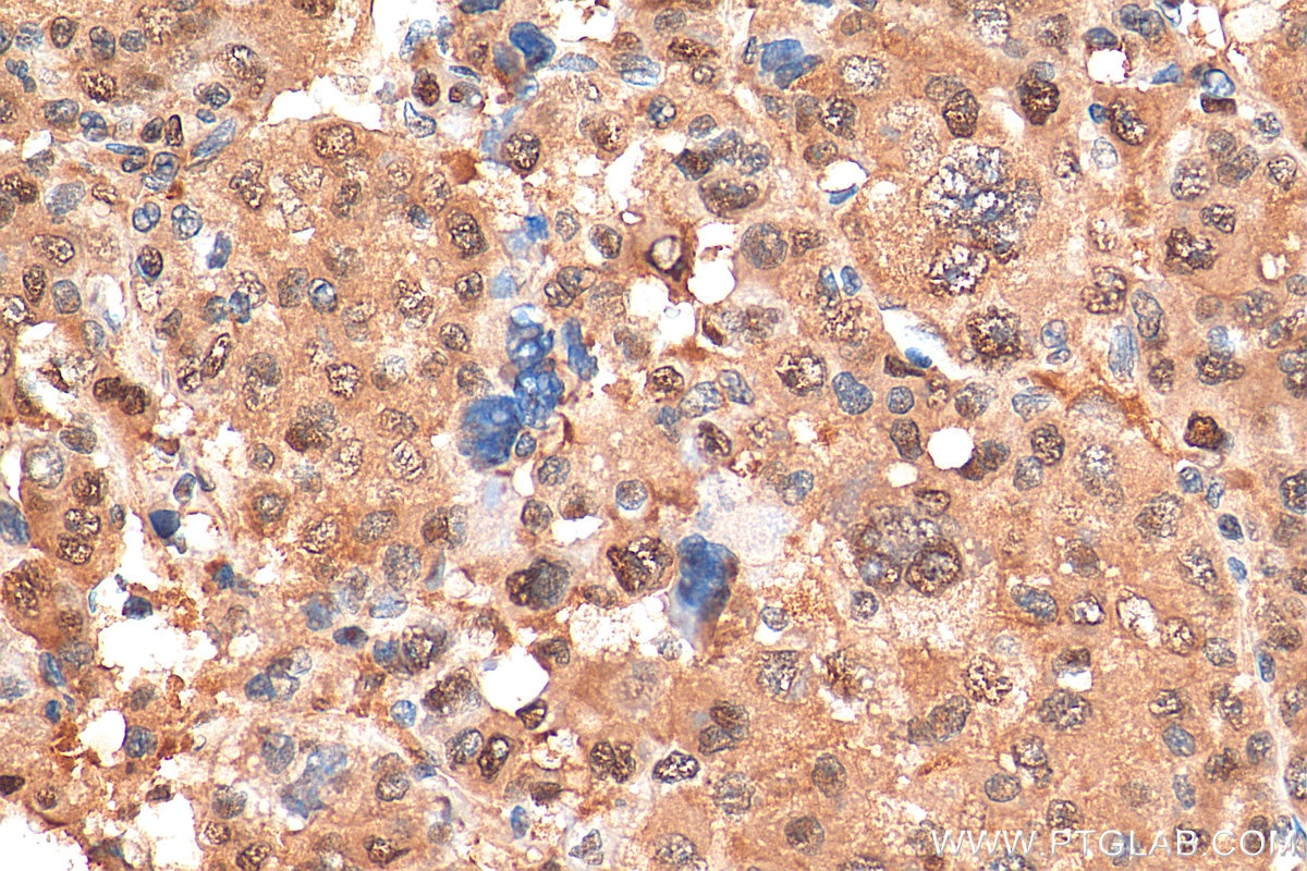 Immunohistochemistry (IHC) staining of human liver cancer tissue using PSMA3 Monoclonal antibody (67938-1-Ig)