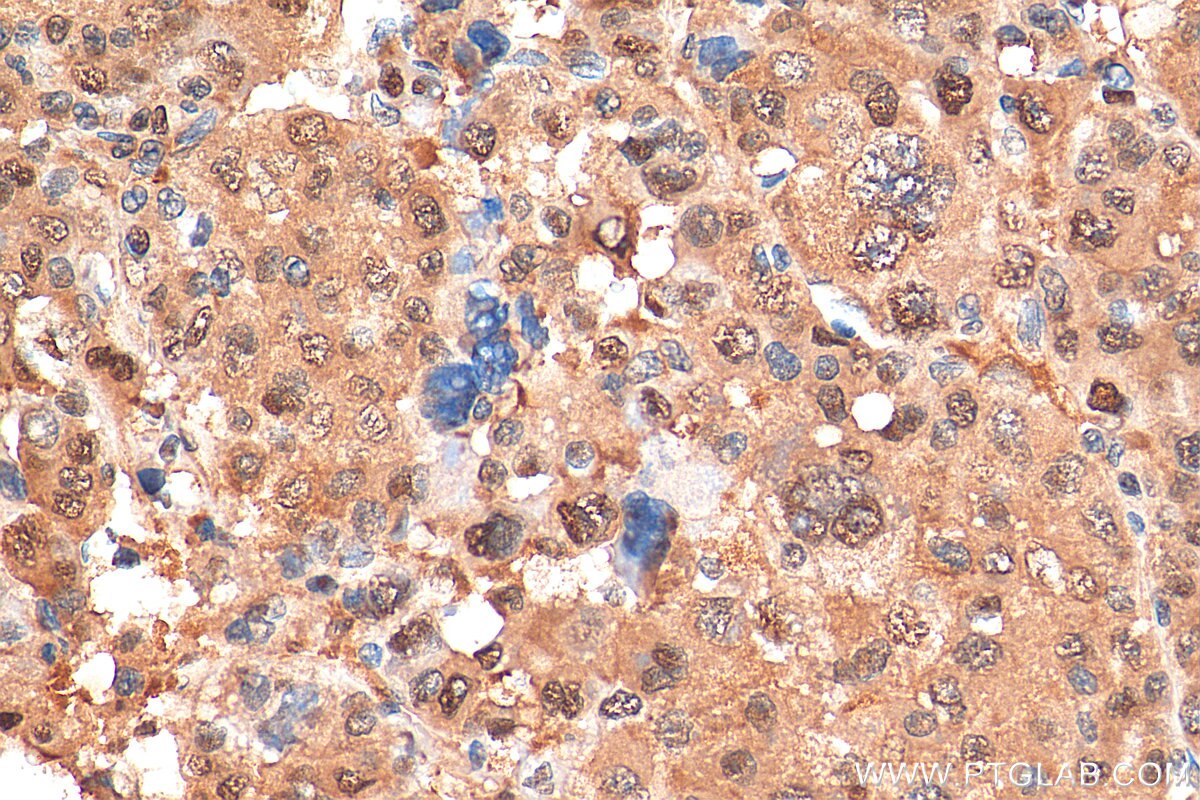 Immunohistochemistry (IHC) staining of human liver cancer tissue using PSMA3 Monoclonal antibody (67938-1-Ig)