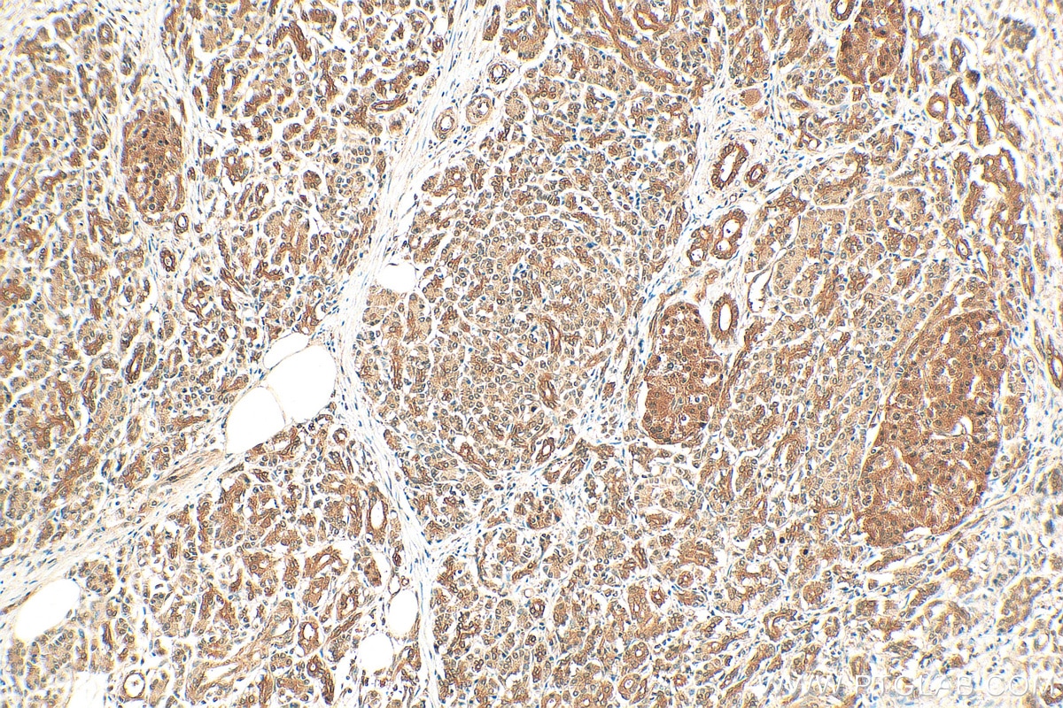 Immunohistochemistry (IHC) staining of human pancreas cancer tissue using PSMA4 Polyclonal antibody (11943-2-AP)