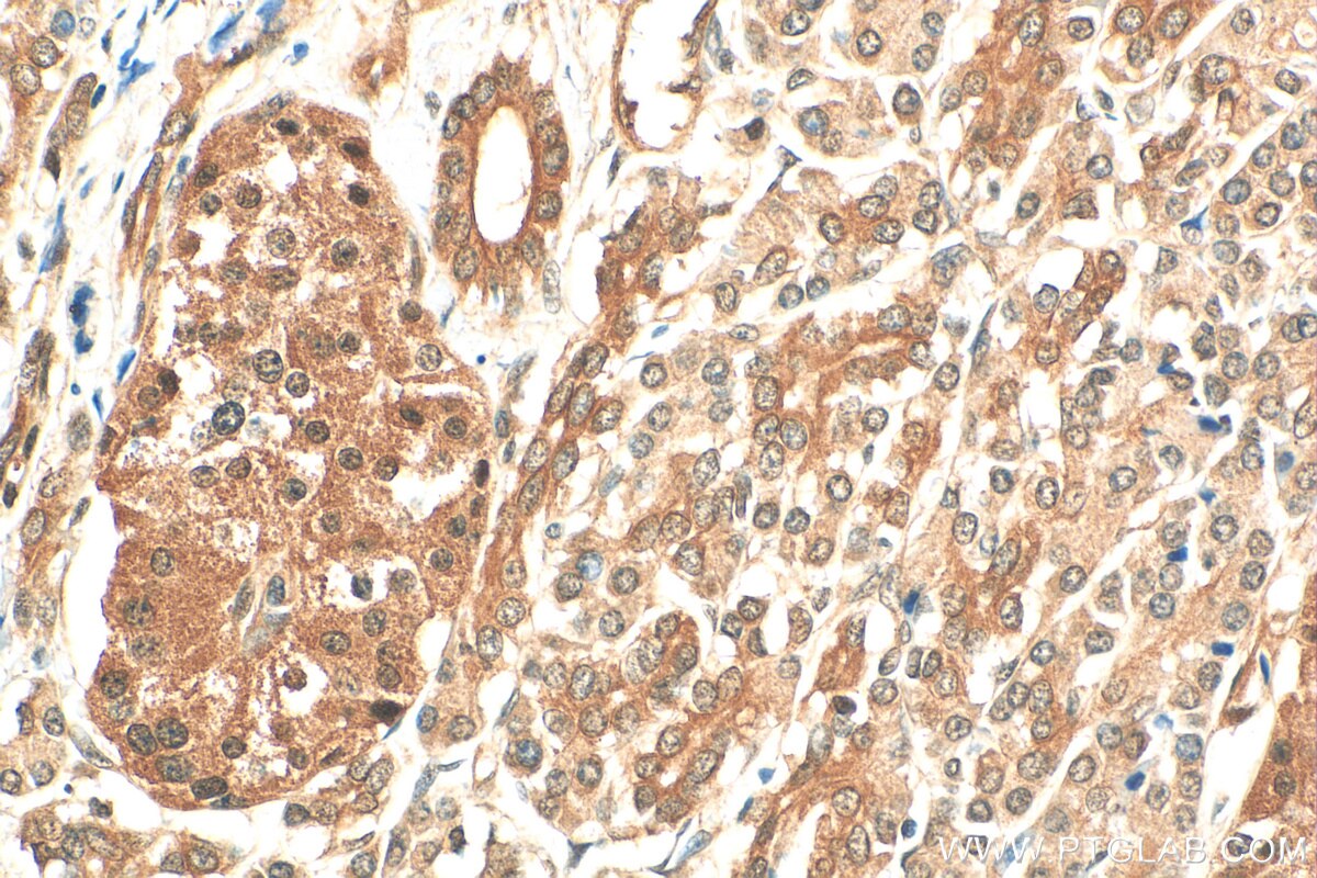 Immunohistochemistry (IHC) staining of human pancreas cancer tissue using PSMA4 Polyclonal antibody (11943-2-AP)