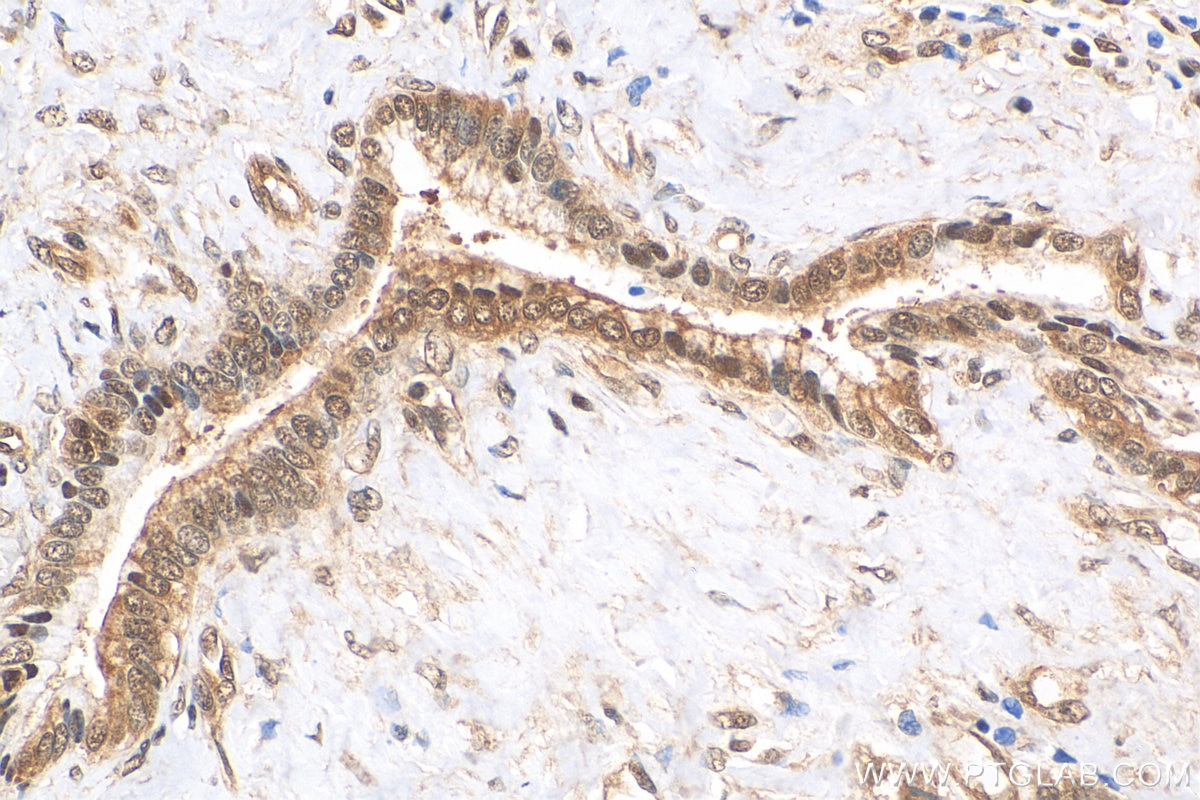 Immunohistochemistry (IHC) staining of human pancreas cancer tissue using PSMA4 Monoclonal antibody (68203-1-Ig)