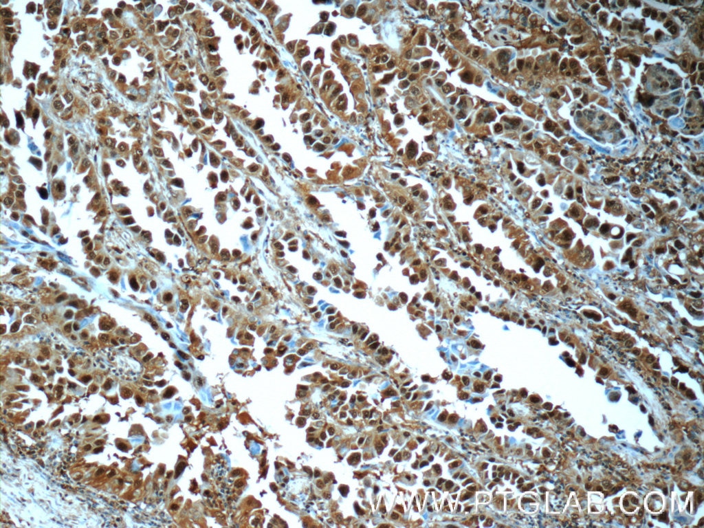 Immunohistochemistry (IHC) staining of human lung cancer tissue using PSMA6 Polyclonal antibody (11573-1-AP)