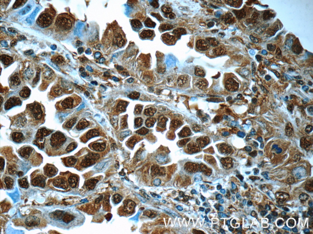 Immunohistochemistry (IHC) staining of human lung cancer tissue using PSMA6 Polyclonal antibody (11573-1-AP)
