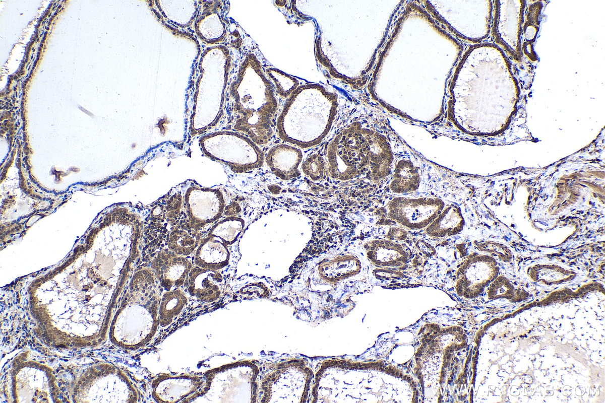 Immunohistochemistry (IHC) staining of human thyroid cancer tissue using PSMA6 Polyclonal antibody (11573-1-AP)