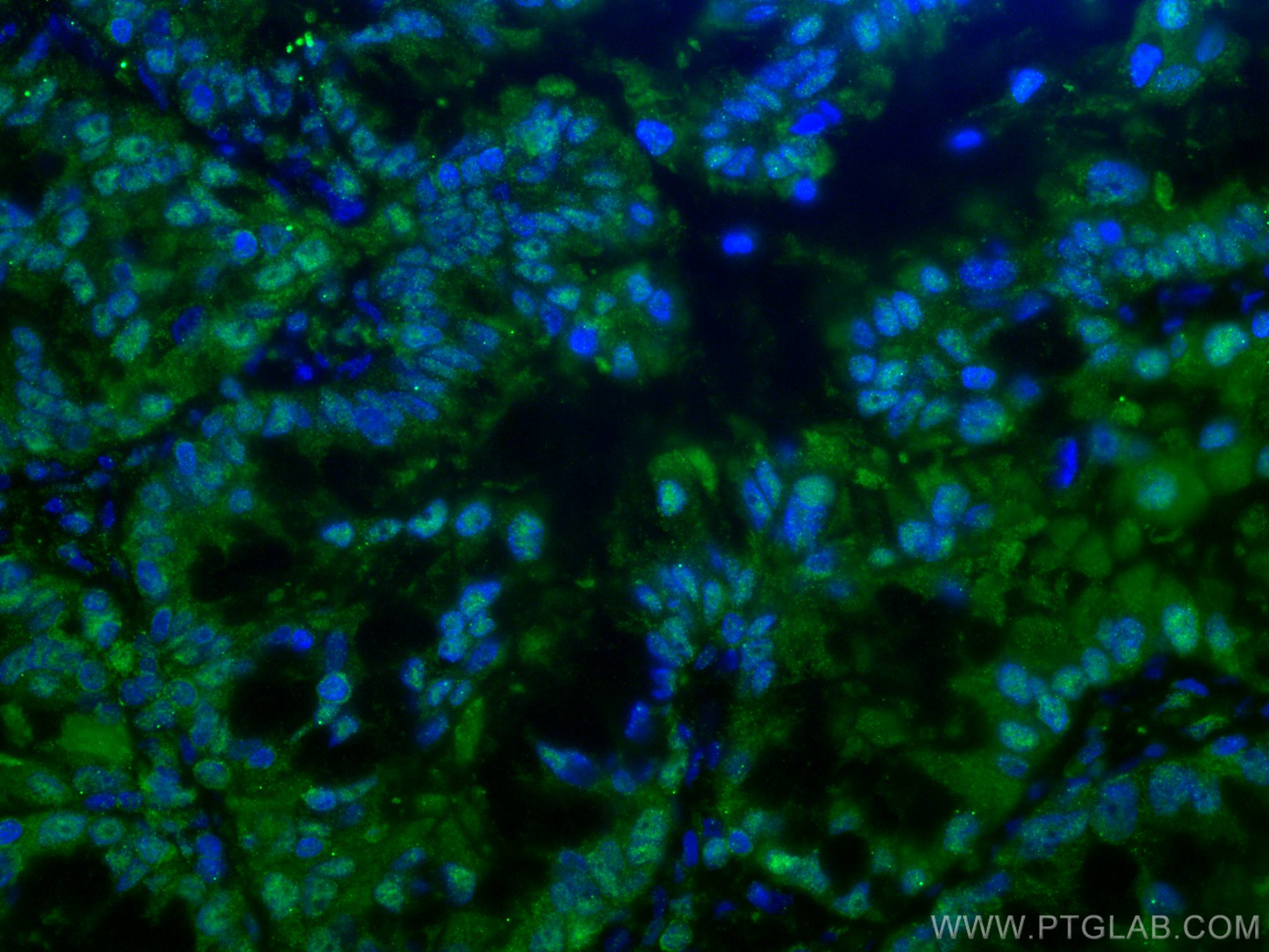 Immunofluorescence (IF) / fluorescent staining of human lung cancer tissue using PSMA6 Monoclonal antibody (67695-1-Ig)