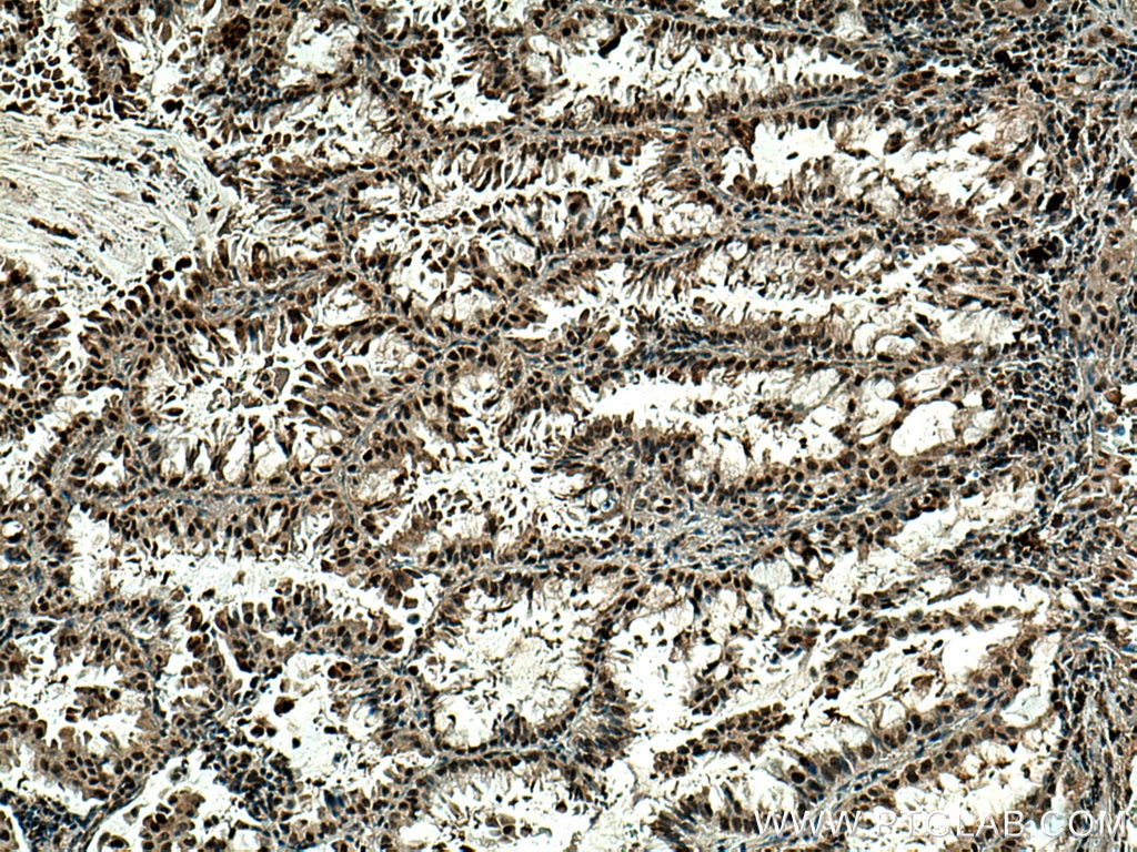 Immunohistochemistry (IHC) staining of human lung cancer tissue using PSMA6 Monoclonal antibody (67695-1-Ig)