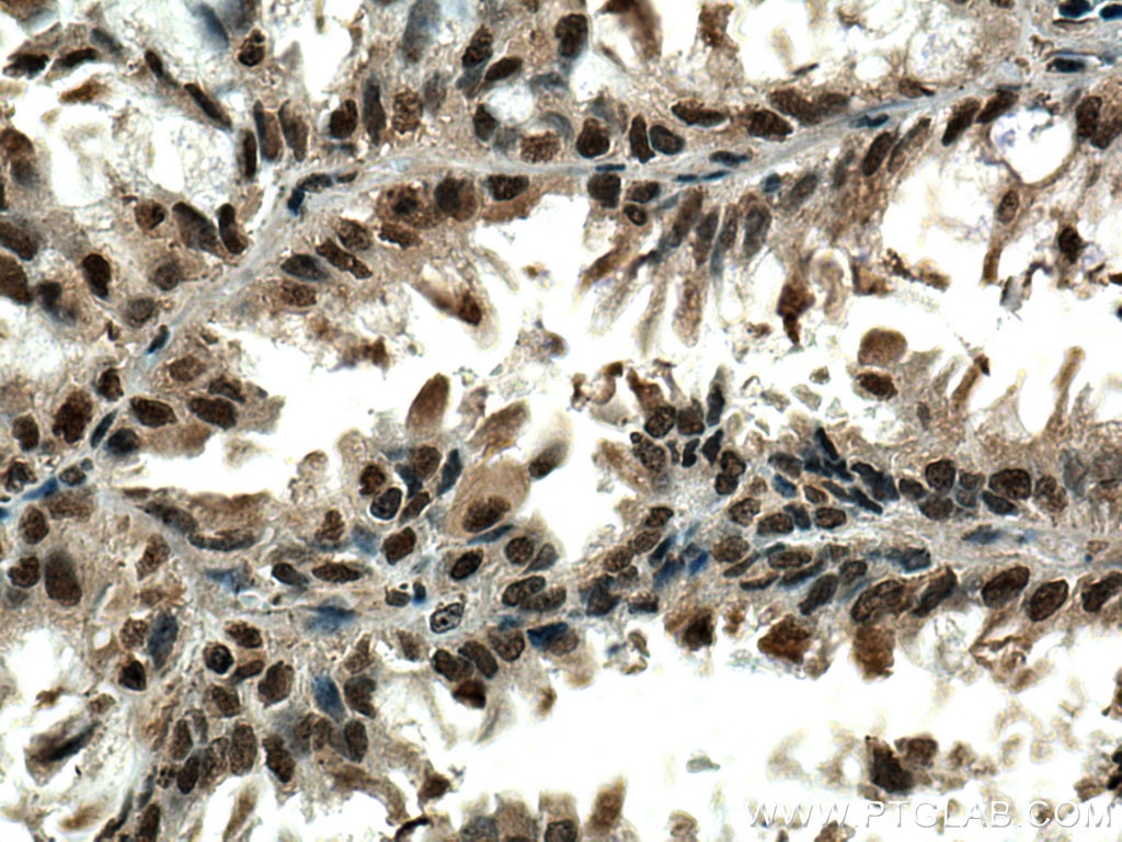 Immunohistochemistry (IHC) staining of human lung cancer tissue using PSMA6 Monoclonal antibody (67695-1-Ig)