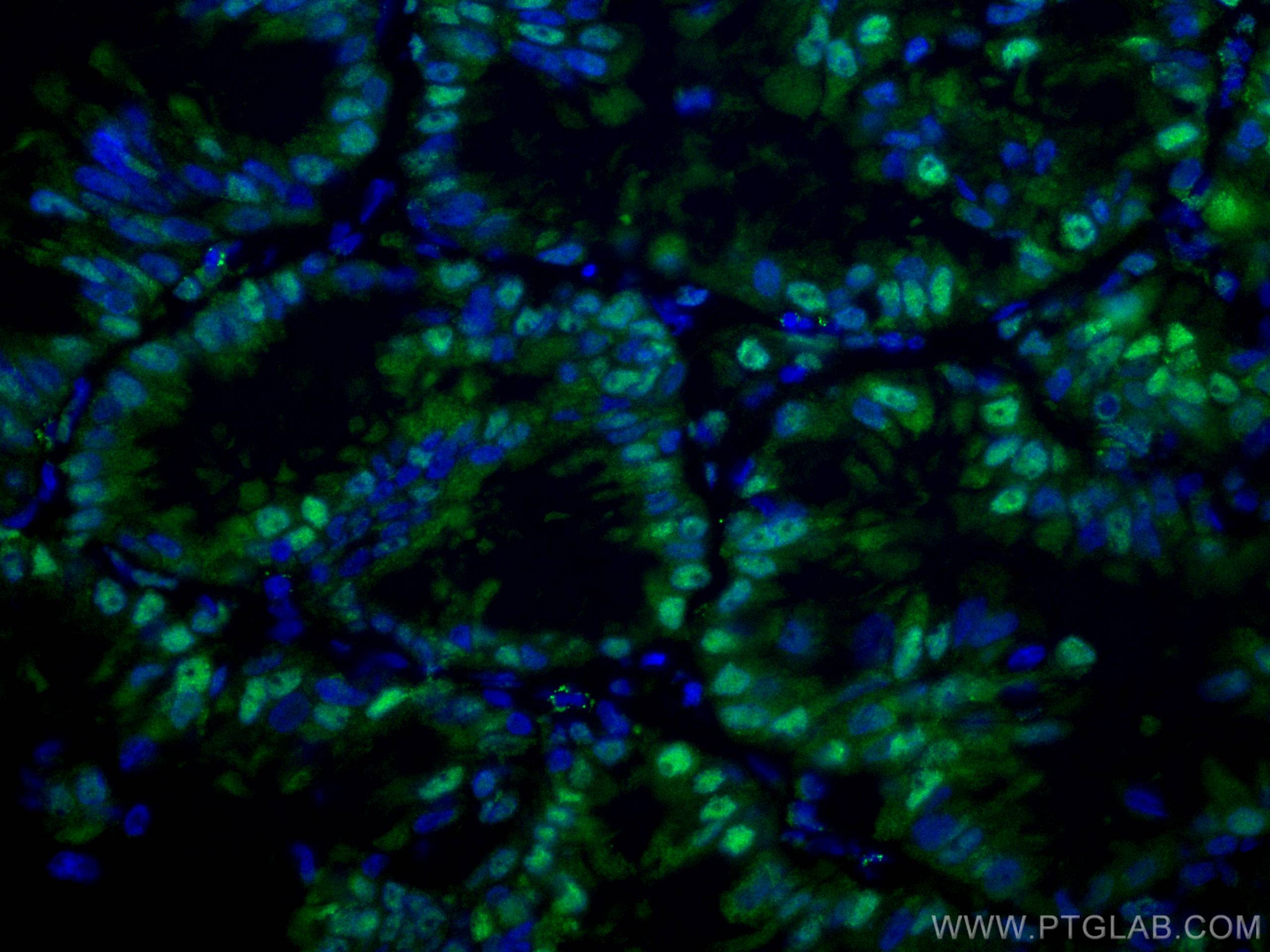 Immunofluorescence (IF) / fluorescent staining of human lung cancer tissue using CoraLite® Plus 488-conjugated PSMA6 Monoclonal ant (CL488-67695)