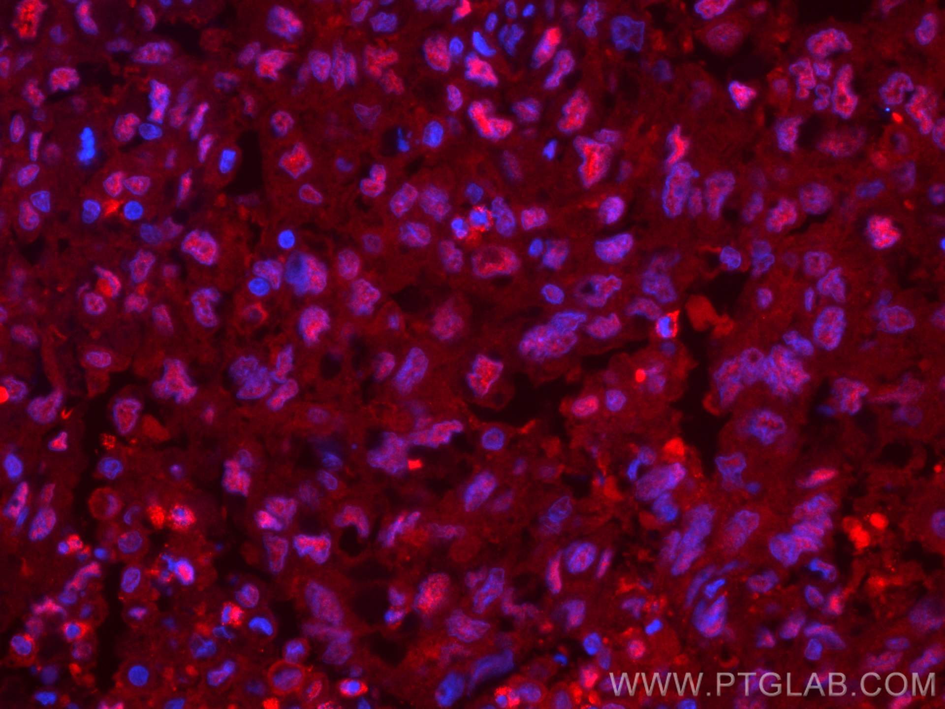 Immunofluorescence (IF) / fluorescent staining of human lung cancer tissue using CoraLite®594-conjugated PSMA6 Monoclonal antibody (CL594-67695)