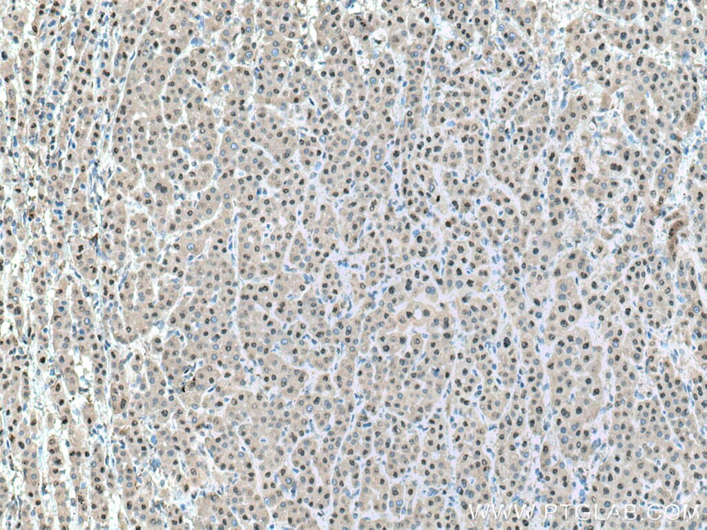 Immunohistochemistry (IHC) staining of human liver cancer tissue using PSMA7 Polyclonal antibody (15219-1-AP)