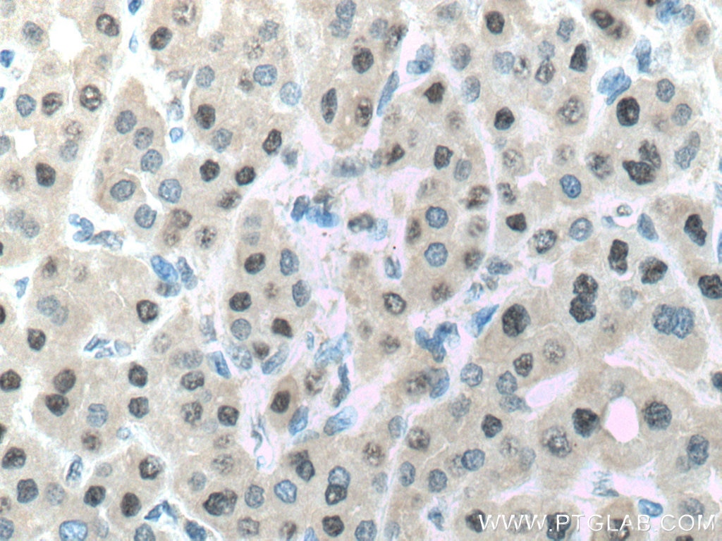 Immunohistochemistry (IHC) staining of human liver cancer tissue using PSMA7 Polyclonal antibody (15219-1-AP)