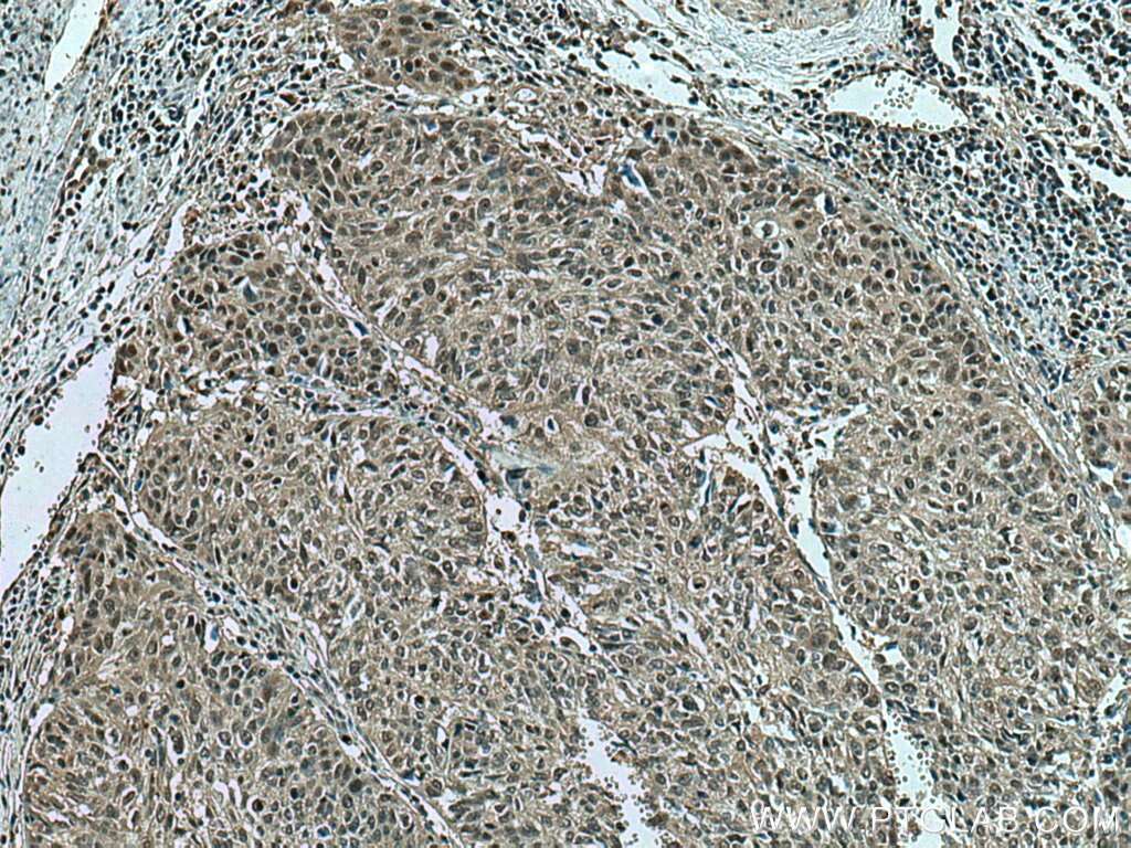 Immunohistochemistry (IHC) staining of human cervical cancer tissue using PSMA7 Monoclonal antibody (67817-1-Ig)