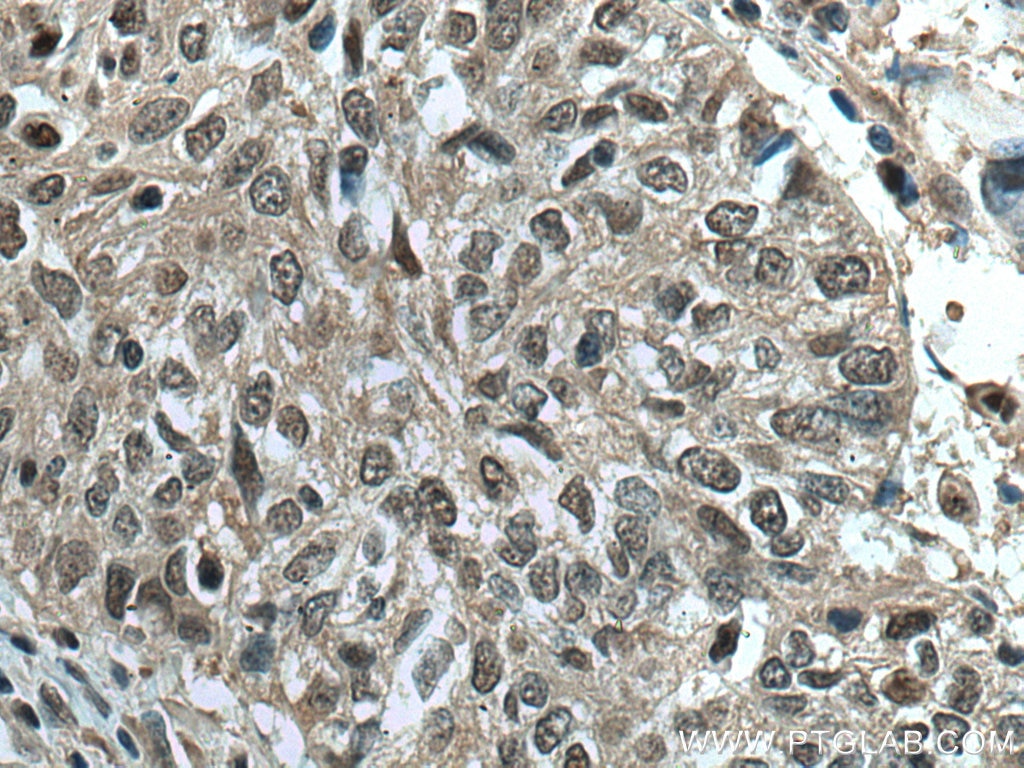 Immunohistochemistry (IHC) staining of human cervical cancer tissue using PSMA7 Monoclonal antibody (67817-1-Ig)