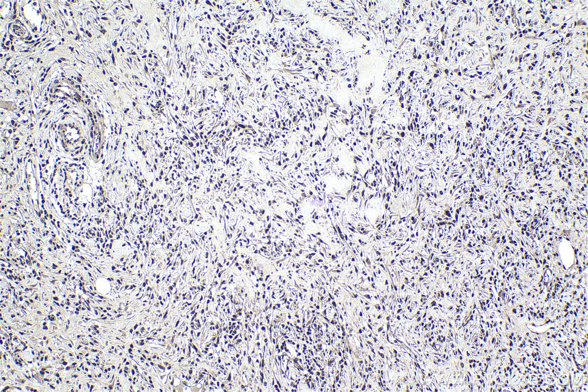 Immunohistochemistry (IHC) staining of human colon cancer tissue using PSMA8 Monoclonal antibody (68123-1-Ig)