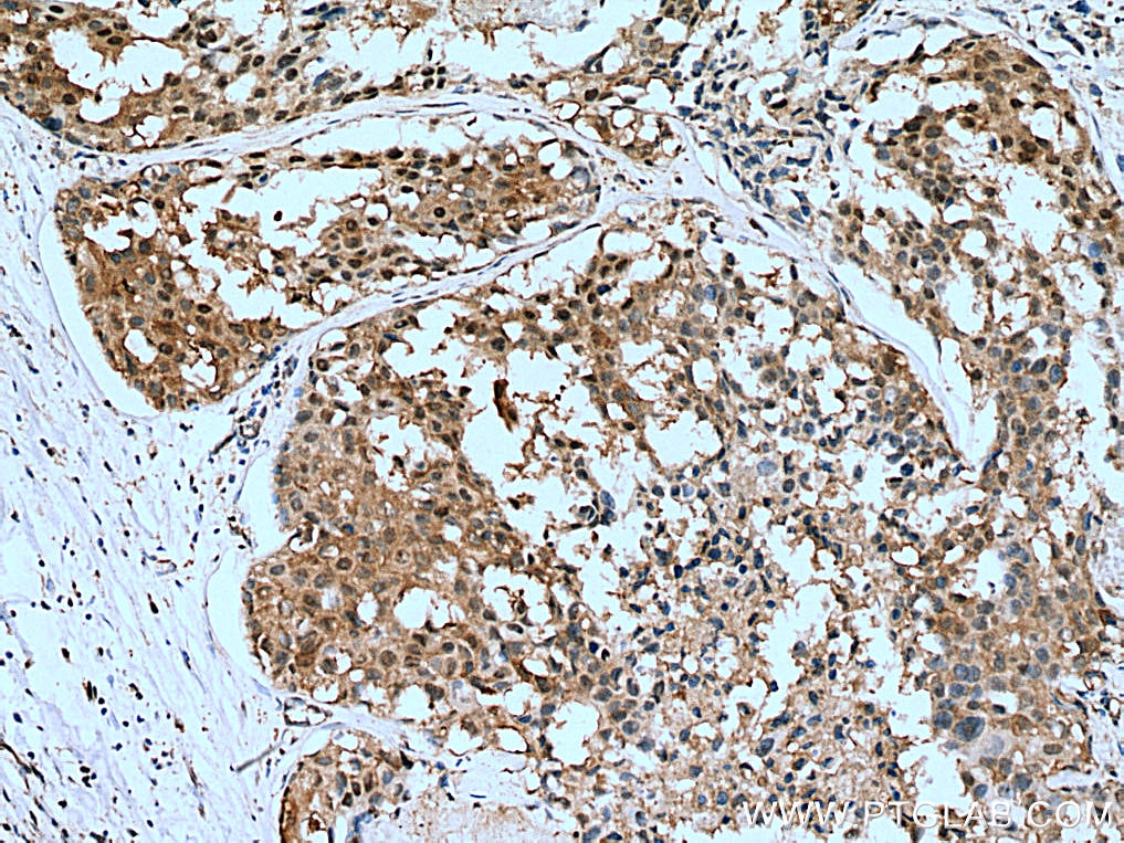 Immunohistochemistry (IHC) staining of human breast cancer tissue using PSMB1 Polyclonal antibody (11749-1-AP)