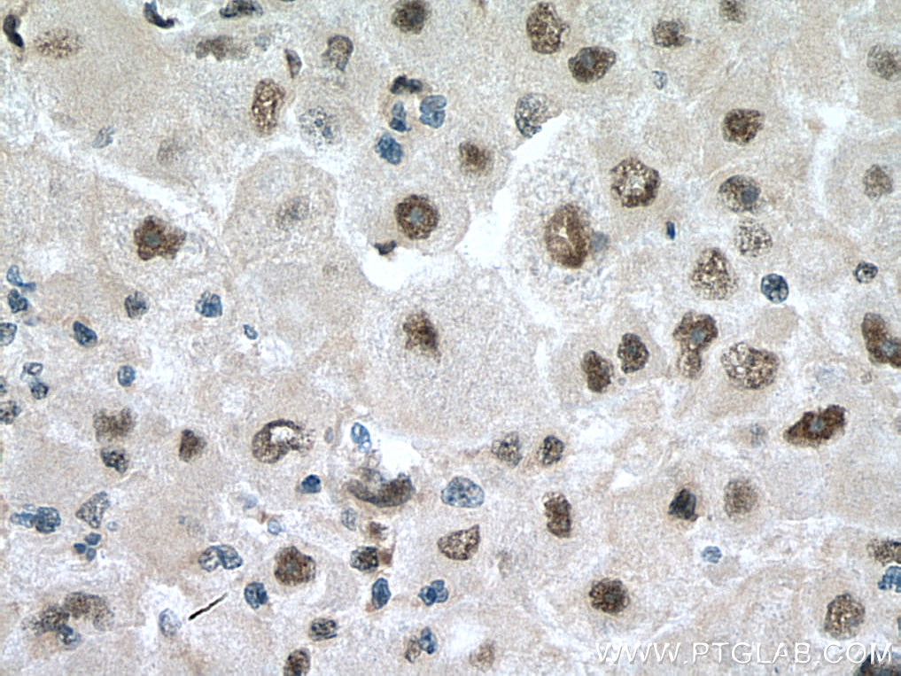 Immunohistochemistry (IHC) staining of human liver cancer tissue using PSMB1 Polyclonal antibody (11749-1-AP)