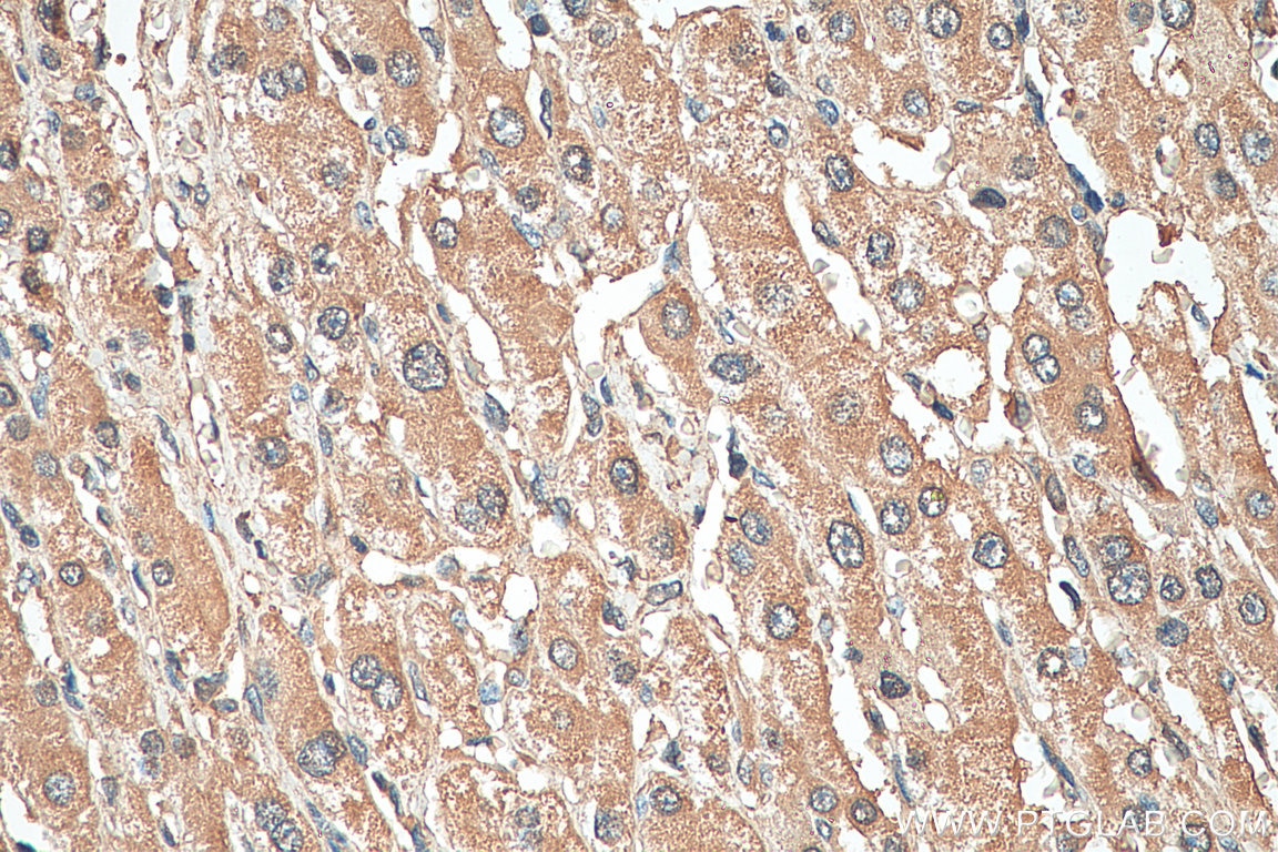 Immunohistochemistry (IHC) staining of human liver cancer tissue using PSMB1 Monoclonal antibody (67847-1-Ig)