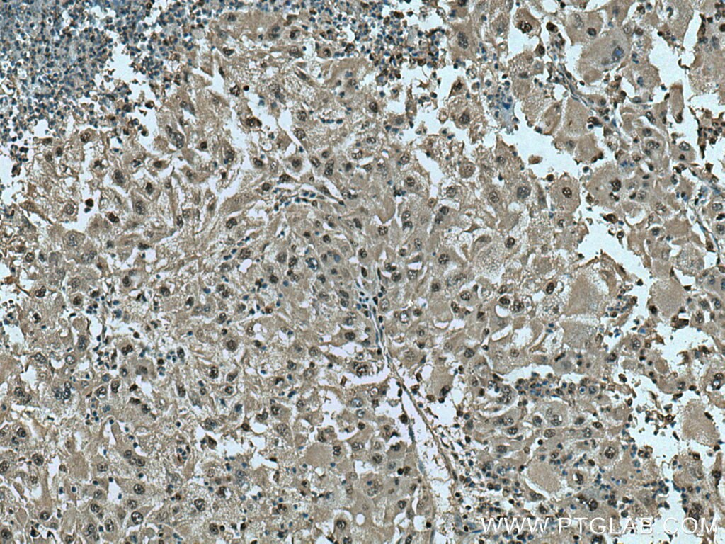 Immunohistochemistry (IHC) staining of human liver cancer tissue using PSMB10 Polyclonal antibody (15976-1-AP)