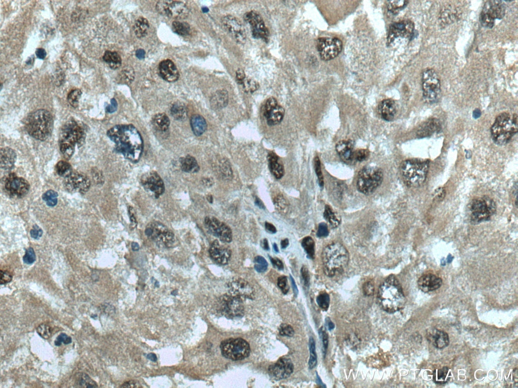 Immunohistochemistry (IHC) staining of human liver cancer tissue using PSMB10 Polyclonal antibody (15976-1-AP)