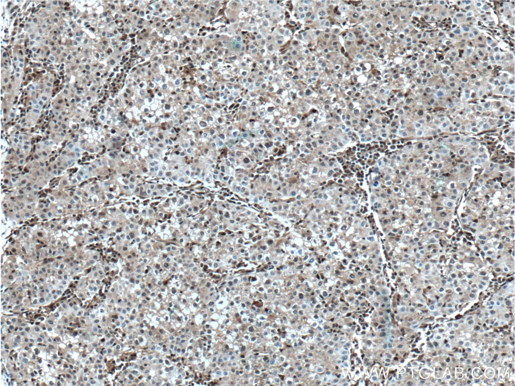 Immunohistochemistry (IHC) staining of human liver cancer tissue using PSMB10 Monoclonal antibody (66403-1-Ig)