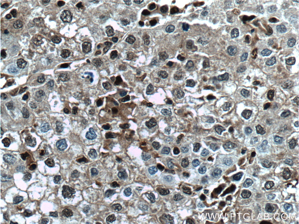 Immunohistochemistry (IHC) staining of human liver cancer tissue using PSMB10 Monoclonal antibody (66403-1-Ig)