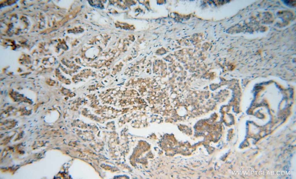 Immunohistochemistry (IHC) staining of human ovary tumor tissue using PSMB2 Polyclonal antibody (15154-1-AP)
