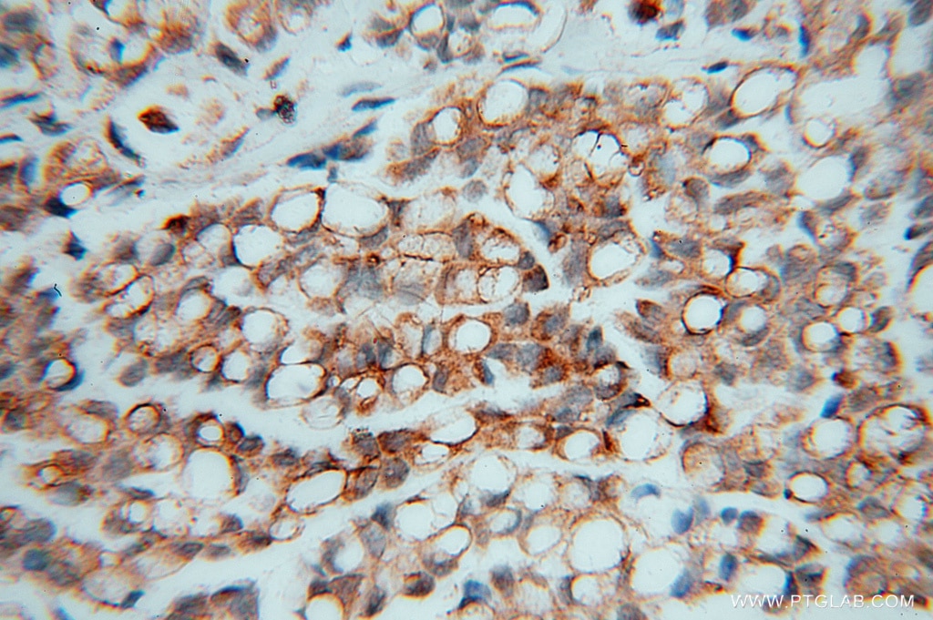 Immunohistochemistry (IHC) staining of human ovary tumor tissue using PSMB2 Polyclonal antibody (15154-1-AP)