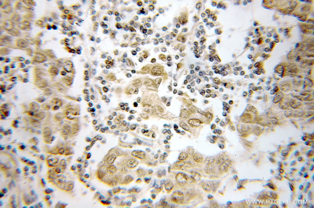 Immunohistochemistry (IHC) staining of human breast cancer tissue using PSMB4 Polyclonal antibody (11029-1-AP)