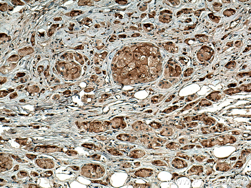Immunohistochemistry (IHC) staining of human breast cancer tissue using PSMB5 Polyclonal antibody (19178-1-AP)