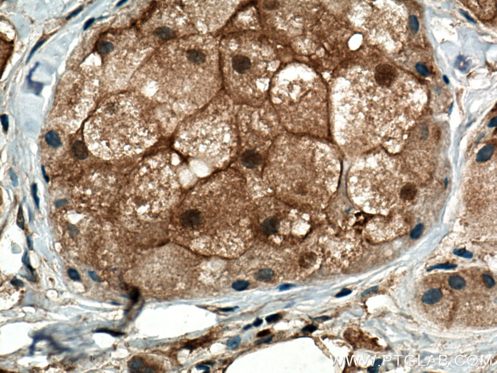 IHC staining of human breast cancer using 19178-1-AP