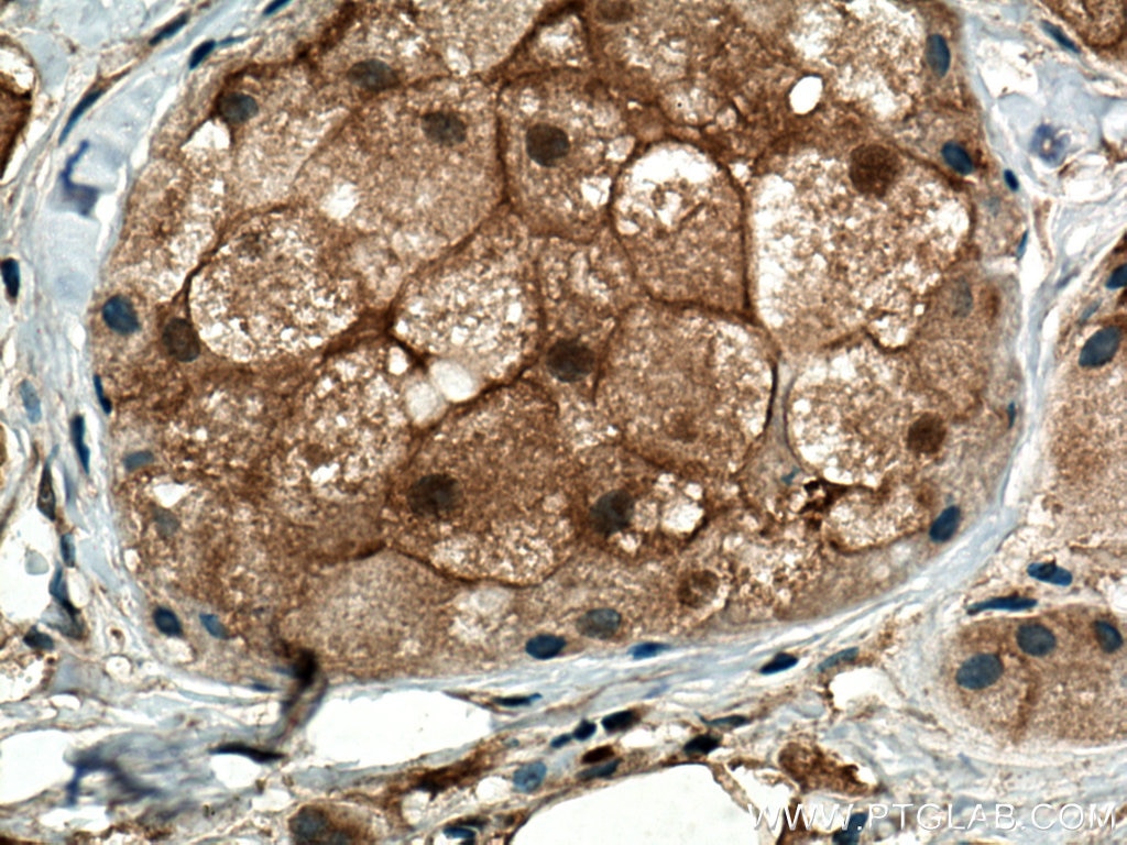 Immunohistochemistry (IHC) staining of human breast cancer tissue using PSMB5 Polyclonal antibody (19178-1-AP)