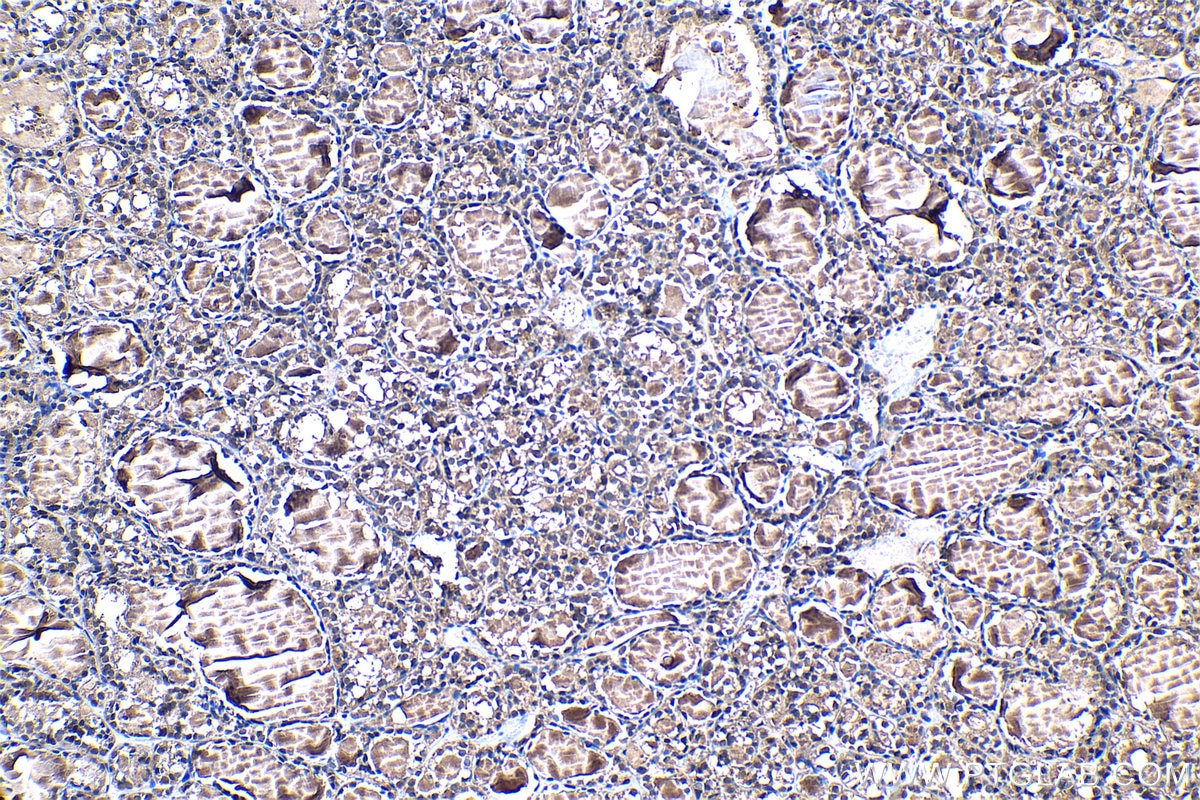 IHC staining of human thyroid cancer using 19178-1-AP Immunohistochemistry (IHC) staining of human thyroid cancer tissue using PSMB5 Polyclonal antibody (19178-1-AP)