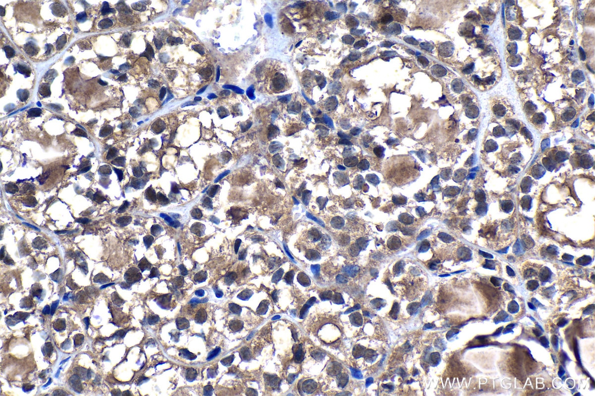 IHC staining of human thyroid cancer using 19178-1-AP Immunohistochemistry (IHC) staining of human thyroid cancer tissue using PSMB5 Polyclonal antibody (19178-1-AP)