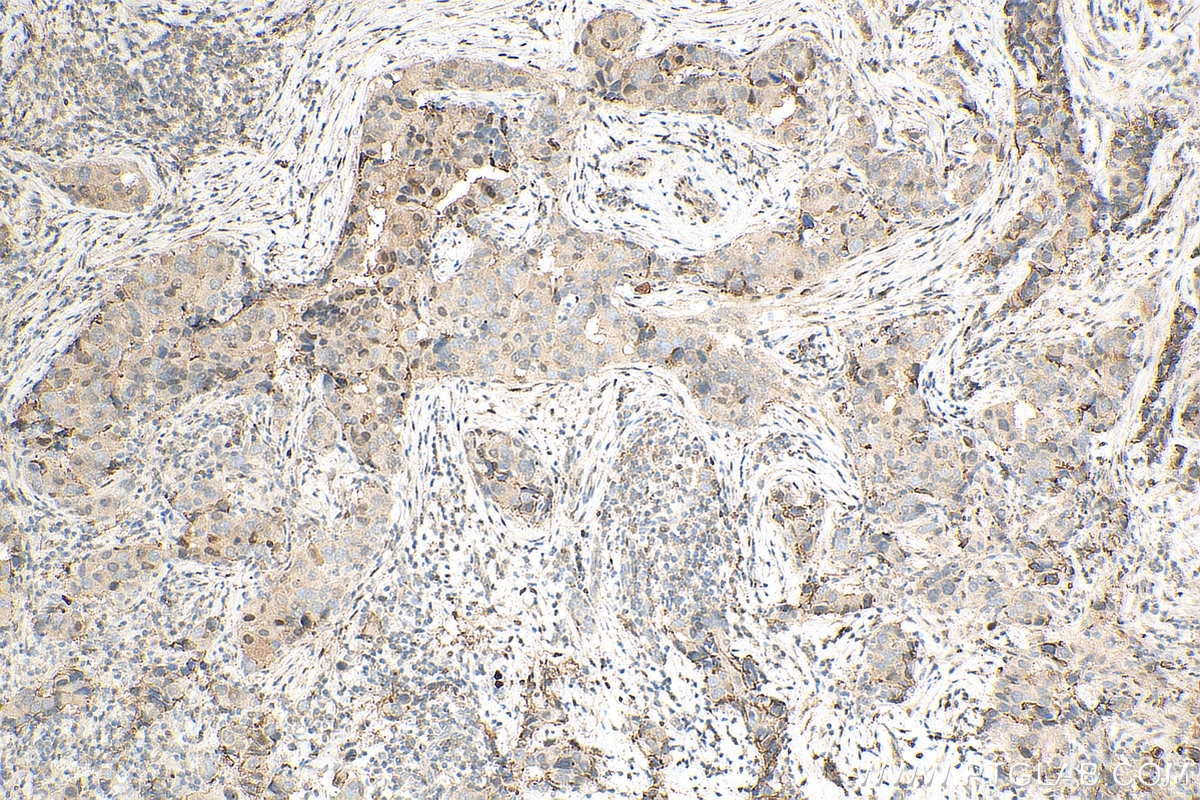Immunohistochemistry (IHC) staining of human breast cancer tissue using PSMB5 Monoclonal antibody (67959-1-Ig)