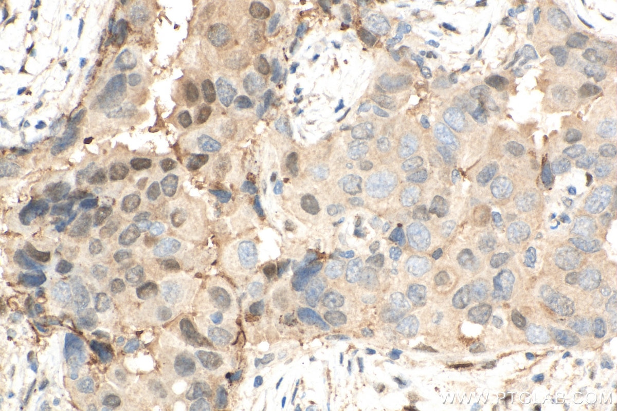 Immunohistochemistry (IHC) staining of human breast cancer tissue using PSMB5 Monoclonal antibody (67959-1-Ig)